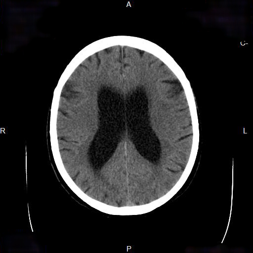 File:Cerebral abscess (Radiopaedia 7606-8431 Axial non-contrast 17).jpg