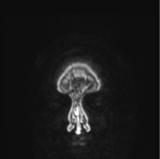 Cerebral abscess from pulmonary arteriovenous malformation (Radiopaedia 86275-102291 L 90).png