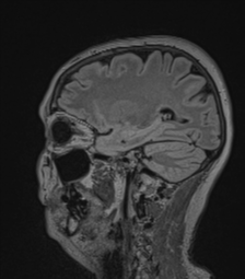 Cerebral abscess from pulmonary arteriovenous malformation (Radiopaedia 86275-102291 Sagittal FLAIR 25).png