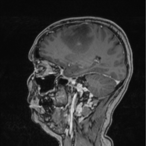 Cerebral abscess from pulmonary arteriovenous malformation (Radiopaedia 86275-102291 Sagittal T1 C+ 50).png