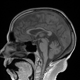 File:Cerebral amyloid angiopathy-related inflammation (Radiopaedia 74836-85849 Sagittal T1 18).jpg