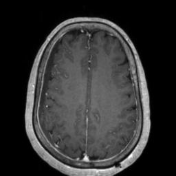 Cerebral amyloid angiopathy (Radiopaedia 29129-29518 Axial T1 C+ 103).jpg