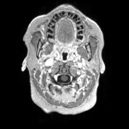 Cerebral amyloid angiopathy (Radiopaedia 29129-29518 Axial T1 C+ 9).jpg