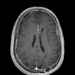 Cerebral amyloid angiopathy (Radiopaedia 29129-29518 Axial T1 C+ 94).jpg