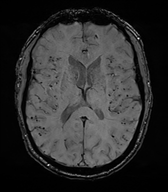 Cerebral amyloid angiopathy (Radiopaedia 46082-50433 Axial SWI 47).png