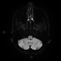 Cerebral amyloid angiopathy (Radiopaedia 77506-89664 Axial DWI 6).jpg