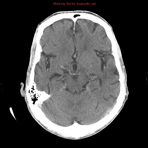File:Cerebral and orbital tuberculomas (Radiopaedia 13308-13310 B 12).jpg