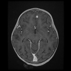 Cerebral and spinal tuberculosis (Radiopaedia 90489-107837 Axial T1 C+ 91).jpg