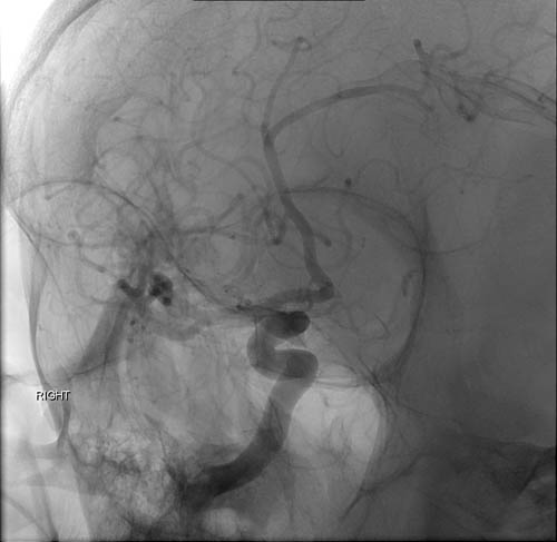 File:Cerebral angiographic projections (Radiopaedia 46308-50712 N 1).jpg
