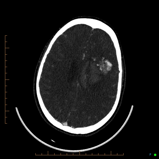 Cerebral arteriovenous malformation (AVM) (Radiopaedia 78162-90706 Axial CTA 183).jpg
