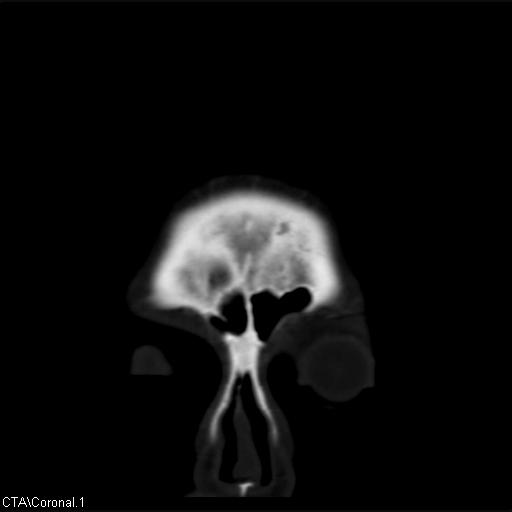 File:Cerebral arteriovenous malformation (Radiopaedia 28518-28759 C 1).jpg
