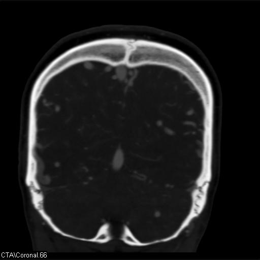 Cerebral arteriovenous malformation (Radiopaedia 28518-28759 C 66).jpg