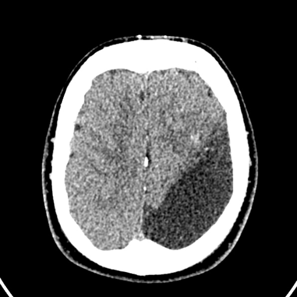 Cerebral arteriovenous malformation (Radiopaedia 37182-39012 Axial non-contrast 38).jpg