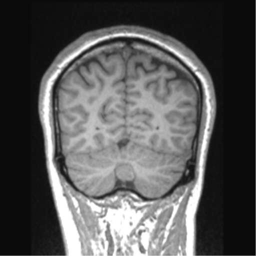Cerebral arteriovenous malformation (Radiopaedia 39259-41506 Coronal T1 23).png