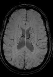 File:Cerebral arteriovenous malformation (Radiopaedia 55798-62372 Axial SWI 24).png