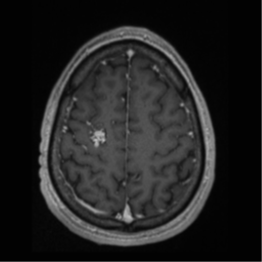 Cerebral arteriovenous malformation (Radiopaedia 55798-62372 Axial T1 C+ 62).png