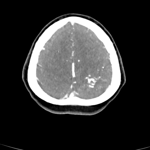 File:Cerebral arteriovenous malformation (Radiopaedia 73830-84645 B 17).jpg