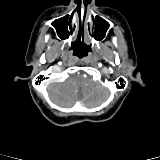 File:Cerebral arteriovenous malformation (Radiopaedia 73830-84645 B 88).jpg
