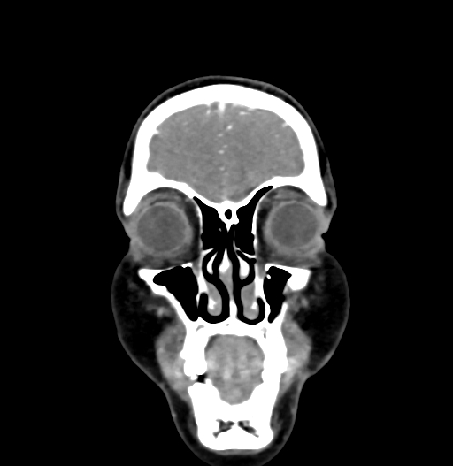 Cerebral arteriovenous malformation (Radiopaedia 73830-84645 C 13).jpg