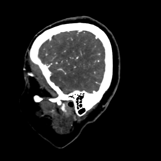 Cerebral arteriovenous malformation (Radiopaedia 73830-84645 Sagittal C+ delayed 12).jpg