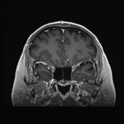 Cerebral arteriovenous malformation (Radiopaedia 84015-99245 Coronal T1 C+ 49).jpg