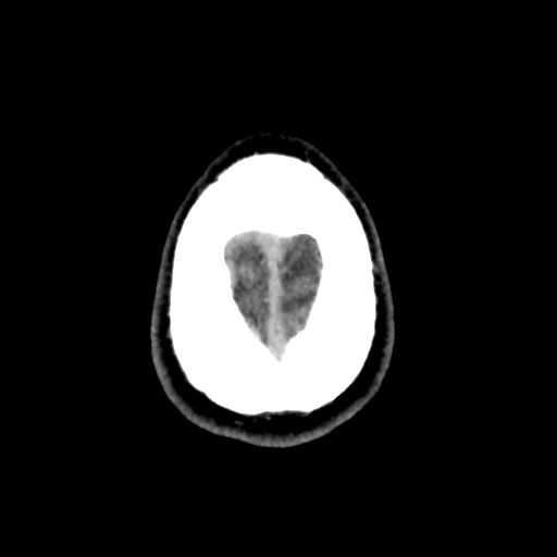 Cerebral arteriovenous malformation (Spetzler-Martin grade 2) (Radiopaedia 41262-44076 Axial non-contrast 52).png