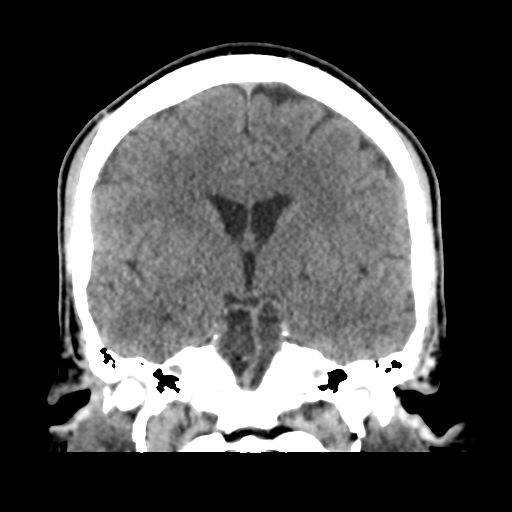 Cerebral arteriovenous malformation (Spetzler-Martin grade 2) (Radiopaedia 41262-44076 Coronal non-contrast 30).png