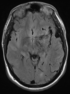 File:Cerebral arteriovenous malformation - huge (Radiopaedia 35734-37272 Axial FLAIR 10).png