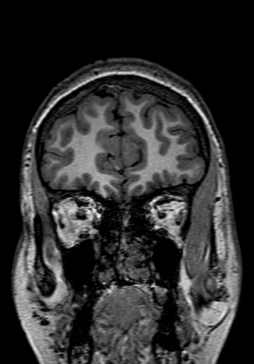 Cerebral arteriovenous malformation at posterior body of corpus callosum (Radiopaedia 74111-84925 Coronal T1 40).jpg
