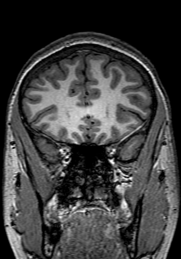 Cerebral arteriovenous malformation at posterior body of corpus callosum (Radiopaedia 74111-84925 Coronal T1 77).jpg
