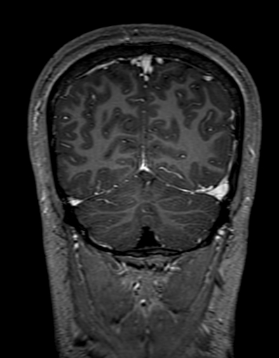 Cerebral arteriovenous malformation at posterior body of corpus callosum (Radiopaedia 74111-84925 K 305).jpg