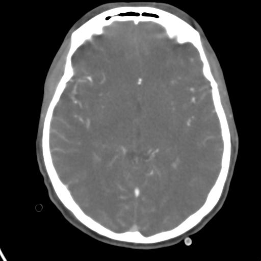 Cerebral arteriovenous malformation with hemorrhage (Radiopaedia 28773-29073 A 30).jpg