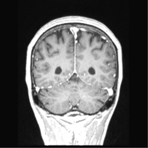 Cerebral arteriovenous malformation with hemorrhage (Radiopaedia 34422-35737 Coronal T1 C+ 26).png
