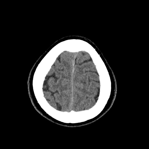 Cerebral arteriovenous malformation with lobar hemorrhage (Radiopaedia 35598-37117 Axial non-contrast 50).jpg