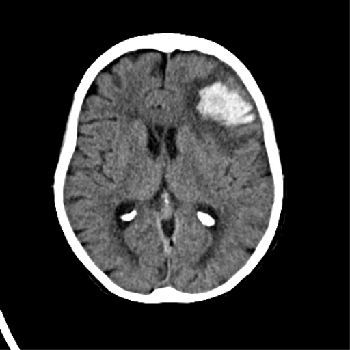 File:Cerebral arteriovenous malformation with lobar hemorrhage (Radiopaedia 44725-48510 Axial non-contrast 23).png