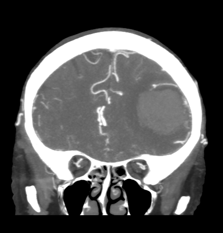 File:Cerebral arteriovenous malformation with lobar hemorrhage (Radiopaedia 44725-48511 B 17).png