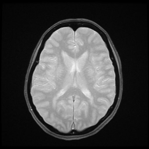 File:Cerebral autosomal dominant arteriopathy with subcortical infarcts and leukoencephalopathy (CADASIL) (Radiopaedia 41018-43768 Ax 2D MERGE 12).png