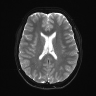 Cerebral cavernous venous malformation (Radiopaedia 70008-80021 Axial DWI 19).jpg