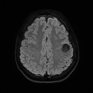 Cerebral cavernous venous malformation (Radiopaedia 70008-80021 Axial DWI 53).jpg