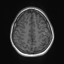 Cerebral cavernous venous malformation (Radiopaedia 70008-80021 Axial T1 65).jpg