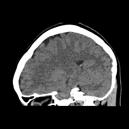 File:Cerebral cavernous venous malformation (Radiopaedia 70008-80022 C 38).jpg