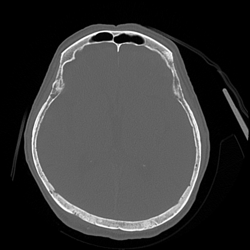 Cerebral contusions, subarachnoid hemorrhage and subdural hygromas (Radiopaedia 55399-61827 Axial bone window 27).png