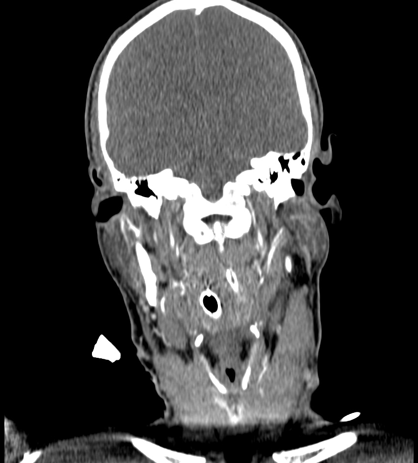 Cerebral edema in an overdose patient (Radiopaedia 72005-82539 B 64).jpg