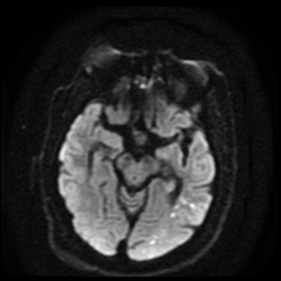 Cerebral embolic infarcts (embolic shower) (Radiopaedia 49837-55108 Axial DWI 77).jpg