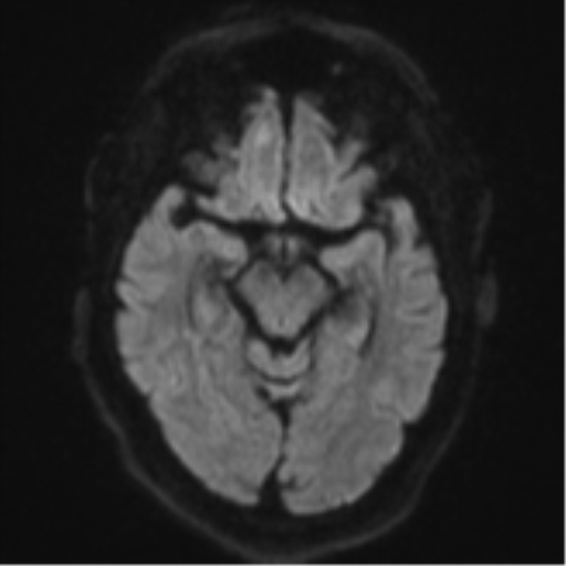 File:Cerebral embolic infarcts (embolic shower) (Radiopaedia 57395-64342 Axial DWI 51).png