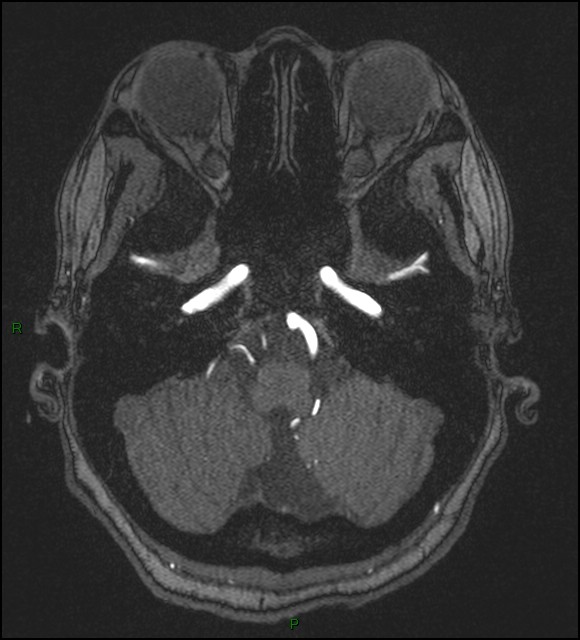 Cerebral fat embolism (Radiopaedia 35022-36525 Axial TOF 34).jpg