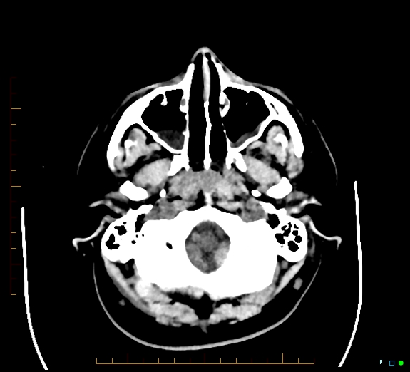 Cerebral fat embolism (Radiopaedia 85521-101220 Axial non-contrast 13).jpg