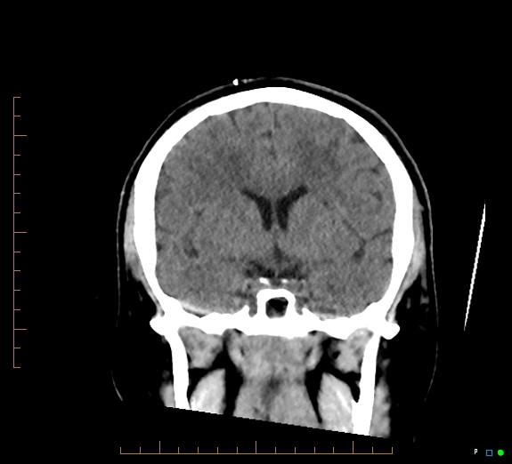 Cerebral fat embolism (Radiopaedia 85521-101220 Coronal non-contrast 28).jpg