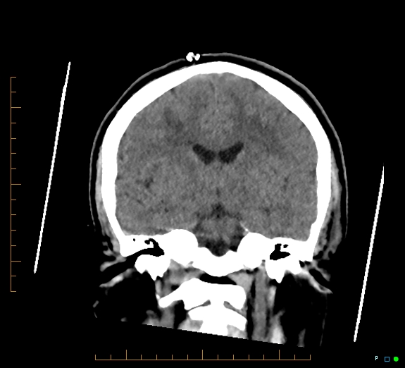 Cerebral fat embolism (Radiopaedia 85521-101220 Coronal non-contrast 33).jpg
