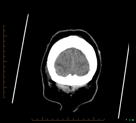 Cerebral fat embolism (Radiopaedia 85521-101220 Coronal non-contrast 59).jpg
